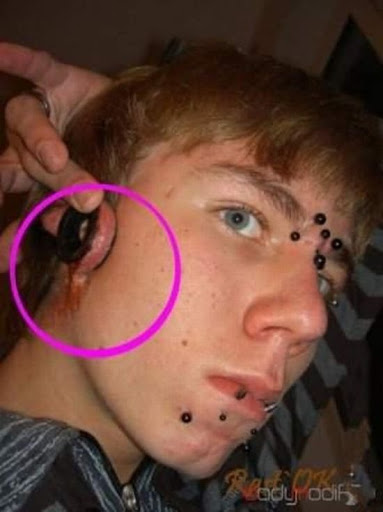 Tenho nota um fórum de acne